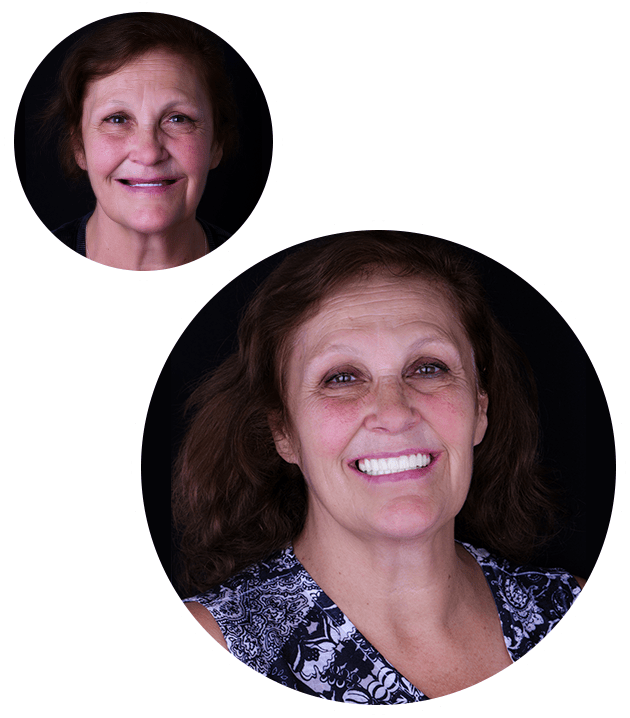 Snap On Dentures Cost in Mexico At 4000 USD Per Arch