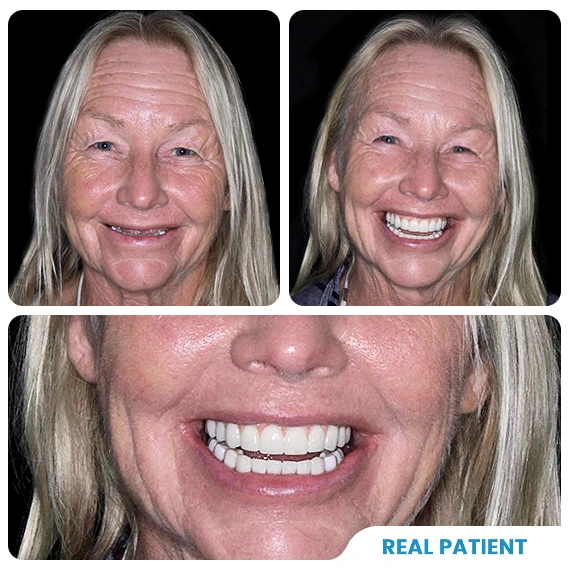 Snap on dentures in Cancun real patient