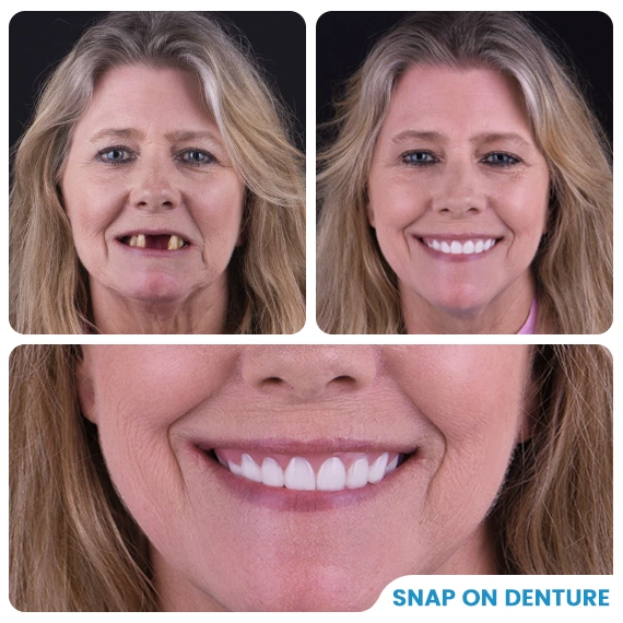 Snap On Dentures in Mexico Cost (2024 Prices)
