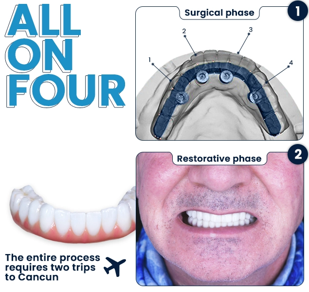 All on 4 dental implant cancun cost (explained)
