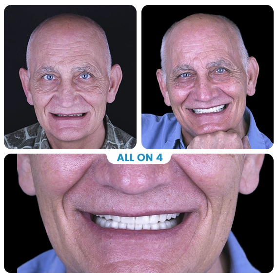 All on 4 dental implants Cancun Mexico Before after