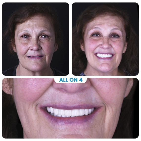 All on 4 dental implants Cancun Mexico Before after 2