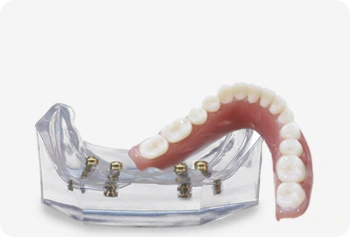 Locator Overdenture
