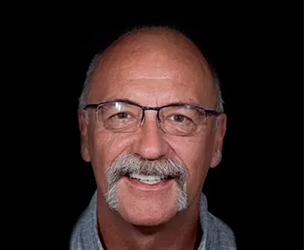 Snap on dentures in Cancun real patient 3