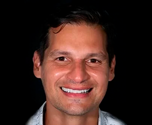 Snap on dentures in Cancun real patient 4