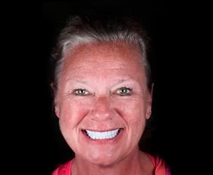 Snap on dentures in Cancun real patient 5