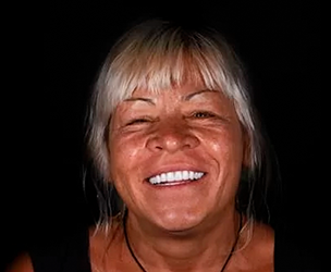 Snap on dentures in Cancun real patient 6