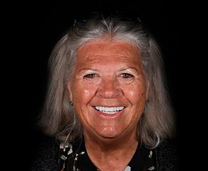 Snap on dentures in Cancun real patient 2