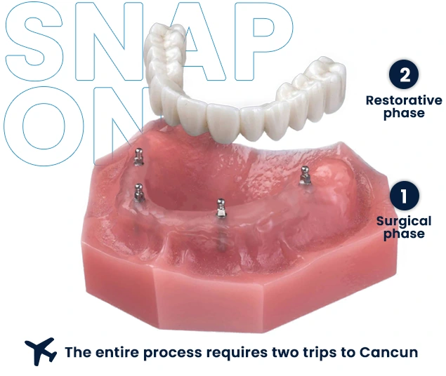 Snap in dentures in Cancun procedure