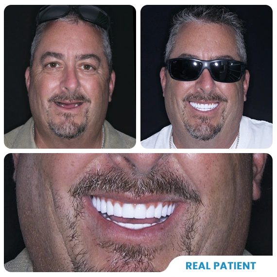 Snap on dentures in Mexico before after