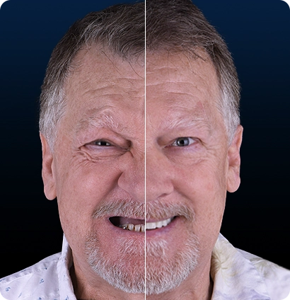 All on 4 dental implants in cancun reviews before after 2