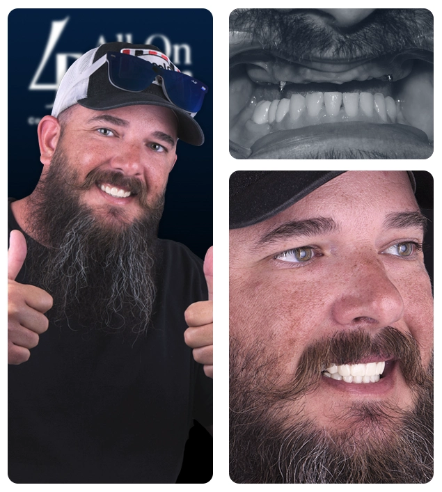 All on 4 dental implants Cancun Mexico before after