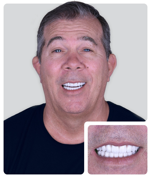 All on 6 dental implants real patient