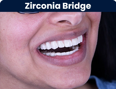 All on 4 Denture with zirconia prettau bridge