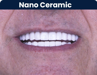 All on 4 Denture with crystal ultra hybrid denture